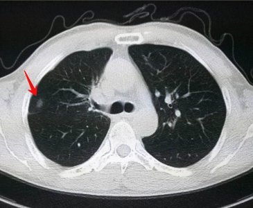 ​肺结节小于多少毫米为良性 肺结节直径小于多少不是癌症了