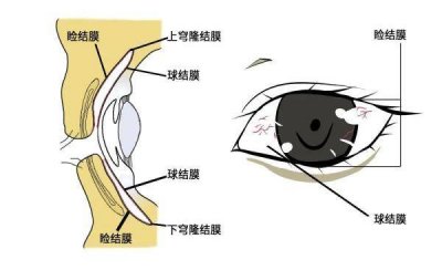 ​眼睛红了就是得了结膜炎吗图片 眼睛红了就是得了结膜炎吗怎么治疗