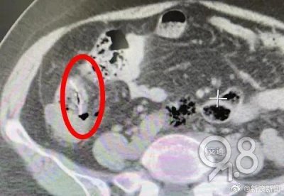 ​大妈卡鱼刺猛吞饭咽下致小肠被扎穿