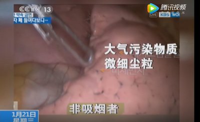 ​内窥镜下的“烟肺”，你见过吗？戒烟后，肺部还能恢复健康吗？