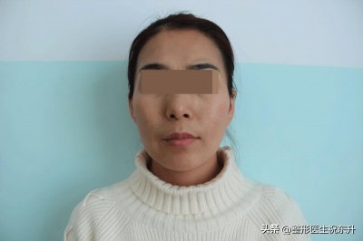 ​全脸脂肪填充第15天，从骨感到幼态，这才是少女的脸