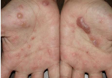 疥疮初期图片和初期症状图片 疥疮早期鉴别诊断