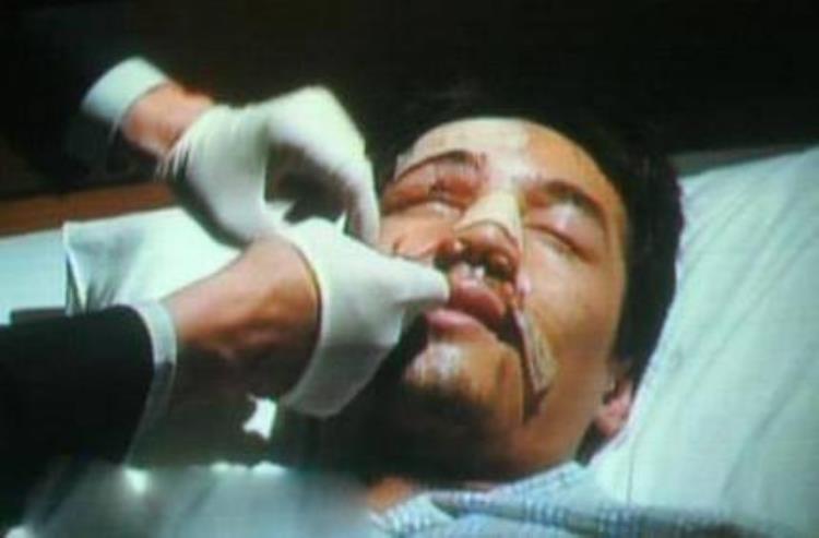 周冬雨下巴的疤痕怎么弄得「素颜的周冬雨下巴现3厘米疤痕而今才知道杨幂爱照半边脸的原因」