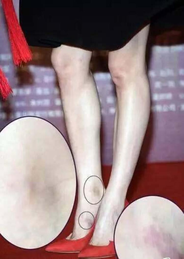 周冬雨下巴的疤痕怎么弄得「素颜的周冬雨下巴现3厘米疤痕而今才知道杨幂爱照半边脸的原因」