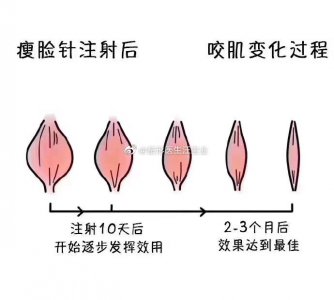 瘦脸针术后对比图