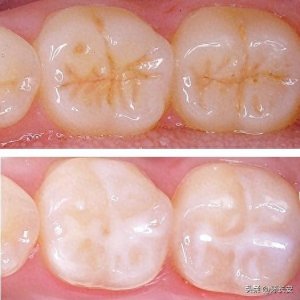 窝沟封闭是智商税吗?口腔医生揭秘:真相与误解全解析