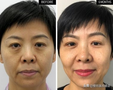 不要轻易做泪沟填充!做完泪沟填充的6个月后,直言坦白几点真相